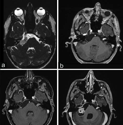 (a) MRI T2 CIS axial demonstrating pre-pontine and ambient cistern... | Download Scientific Diagram