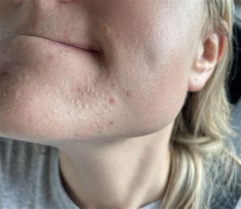 [Acne] Chin has been like this for years. They can be squeezed out but ...