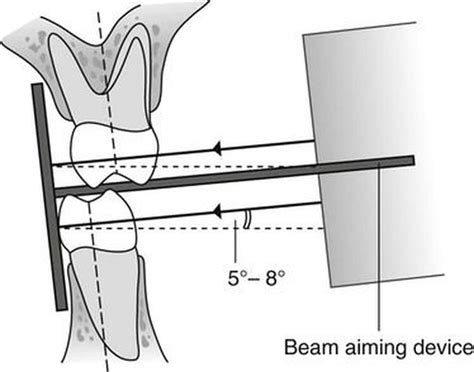 Bitewing radiograph technique - MEDizzy