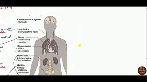 Extrapulmonary TB - YouTube