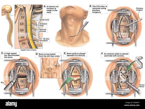 Anterior Cervical Spinal Fusion Surgery