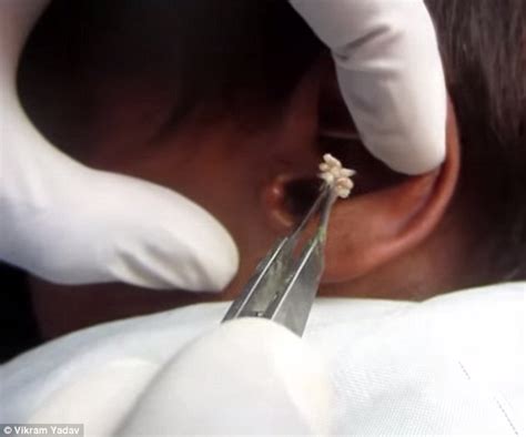 Juliana Francis Blog: Man develops maggot infestation in his EAR after ...