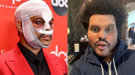 The Weeknd Keeps Freaking Us Out With His Botched Plastic Surgery Face | lifewithoutandy