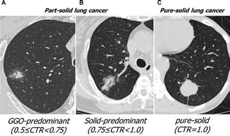 Importance of Ground Glass Opacity Component in Clinical Stage IA ...