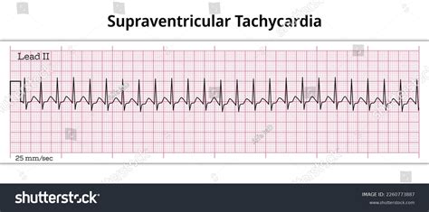 4,792 Tachycardia Images, Stock Photos, 3D objects, & Vectors | Shutterstock