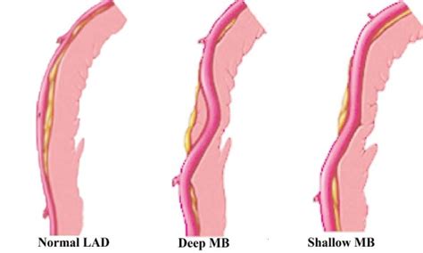 Myocardial Bridges a Review of the Imaging Studies for Diagnosis