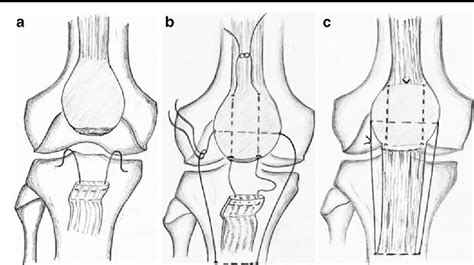 Patellar Tendon Rupture Repair