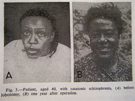 Famous Lobotomy Patients