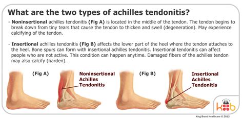 Achilles Tendonitis Treatment