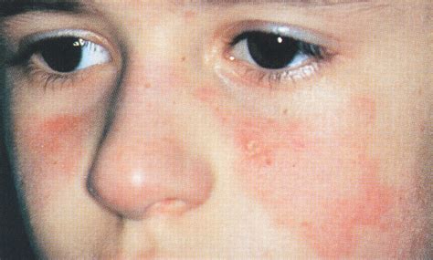 Malar Rash in a Child—Quiz Case. | Dermatology | JAMA Dermatology ...