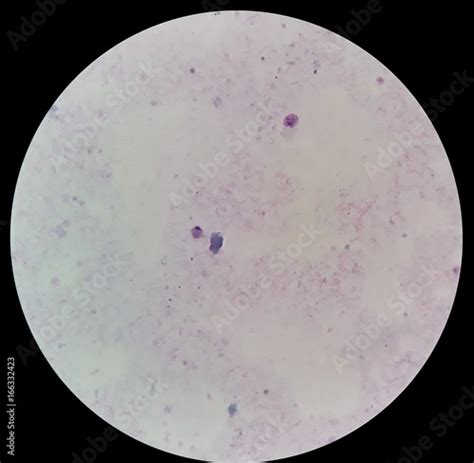 Under 100X light microscope, human parasite on thick film of blood smear with Plasmodium ...