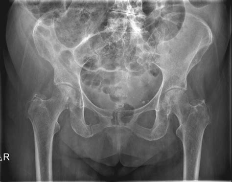 pubic-rami-fracture - RCEMLearning India