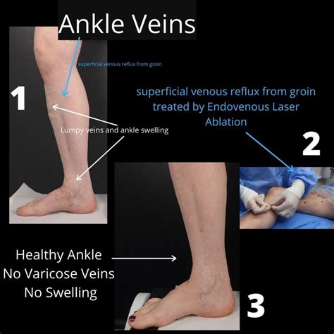 Veins Around Ankles | The VeinCare Centre