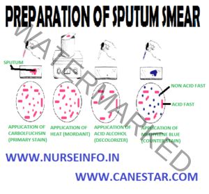 PREPARATION OF SPUTUM SMEAR - Nurse Info PREPARATION OF SPUTUM SMEAR – Sputum, Purpose of Sputum ...