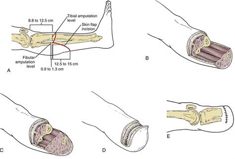 Amputation causes, types of amputation and amputation complications