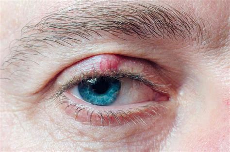 Chalazion Surgery: Prep, Recovery, Long-Term Care