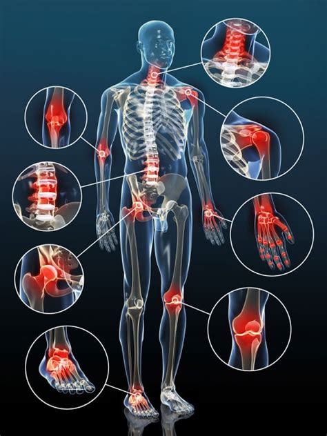 How to Manage Osteoarthritis (OA) - Max Health Institute & Physiotherapy