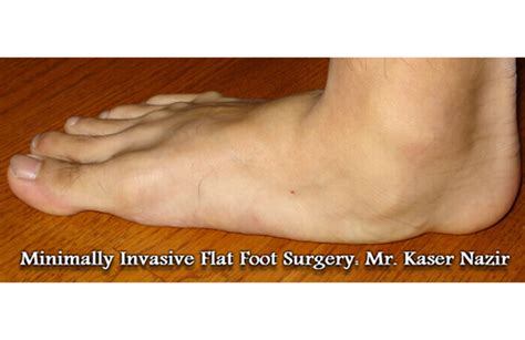 Minimally Invasive Flat Foot Surgery: Mr. Kaser Nazir ...