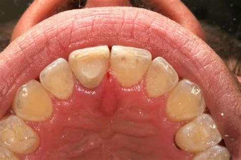 Internal and External Bleaching of Teeth - Homeopathic Dentistry