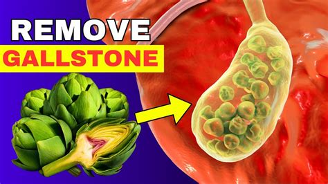 8 Food Remove Gallbladder Stones Without Surgery Gallbladder Stones Symptoms - YouTube