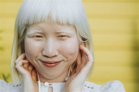Albinism: Causes, Types, and Symptoms - Cure Chiropractic