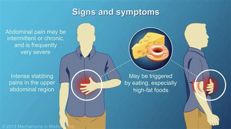 Acute Pancreatitis Signs And Symptoms