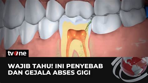 Penyebab Dan Gejala Abses Gigi | tvOne - YouTube