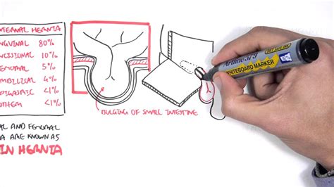 Direct Inguinal Hernia Anatomy