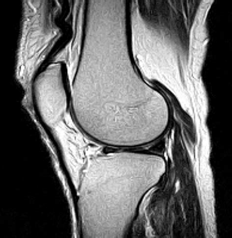 Knee Mri Scan Medserena Open Mri - vrogue.co