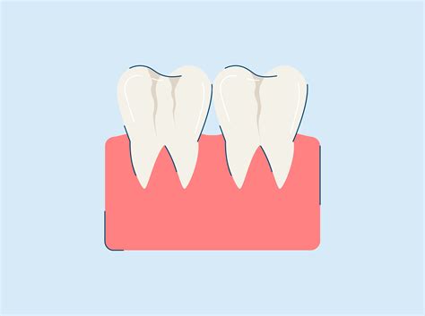 What are Craze Lines? Causes and Treatment