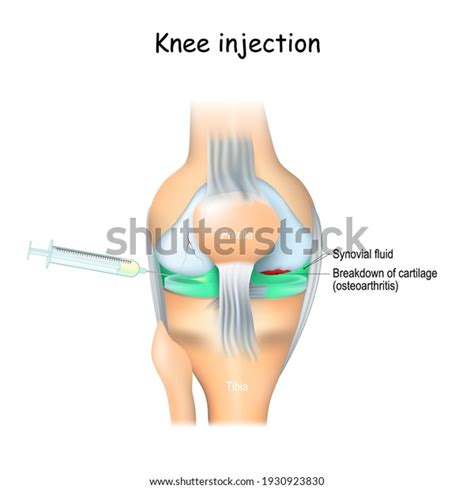 Knee Injections Treatment Joint Pain Knee Stock Vector (Royalty Free ...