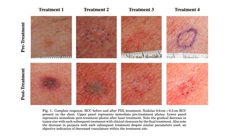 New non-invasive treatment of basal cell carcinoma