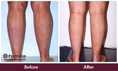 Non Surgical Calf Fat Reduction in Mumbai | Prettislim