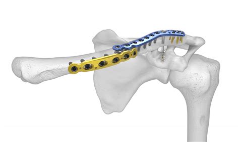 Clavicle Plate with Acu-Sinch Anterior Plate | Acumed