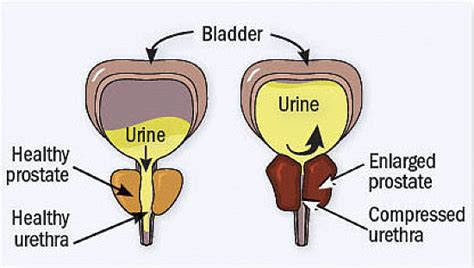 10 benign prostatic hyperplasia (BPH) facts - Chronic Kidney Disease ...