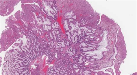 Inflammatory type polyp of the colon | Atlas of Pathology