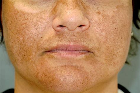 Melasma & Hyperpigmentation Treatment In London | Skin Care Network