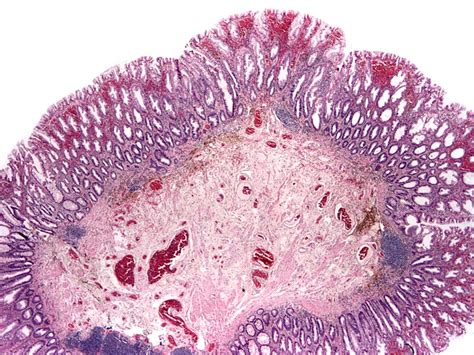 Pathology Outlines - Sessile serrated adenoma