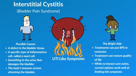 Treatment for Interstitial Cystitis - Philadelphia Holistic Clinic - Dr. Tsan