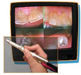 Intraoral Cameras | Smile Columbia Dentistry