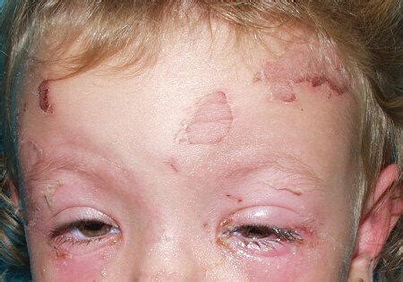 Staphylococcal scalded skin syndrome