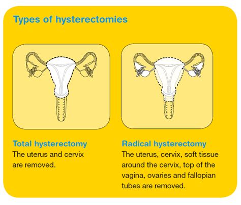 10 Things To Know About Hysterectomy Surgeries Types Of Hysterectomy ...