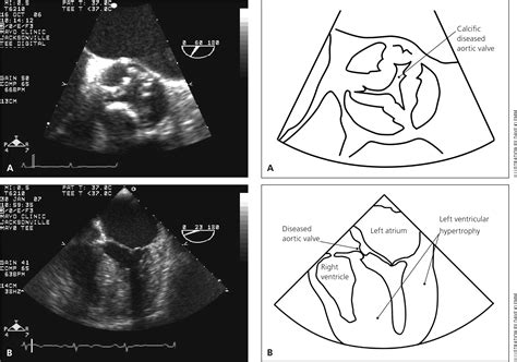 Aortic Stenosis: Diagnosis and Treatment | AAFP