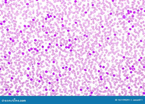 Picture of Leukemia Cells in Blood Smear Stock Image - Image of lymphoblastic, blood: 161199291