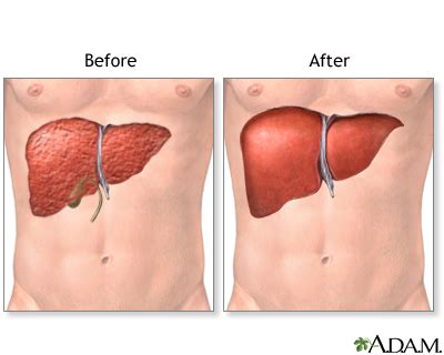 In-Depth Reports - Liver transplant - series