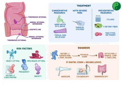 Natural Remedies for Hemorrhoids