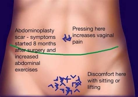 Pin on Nerve Pain