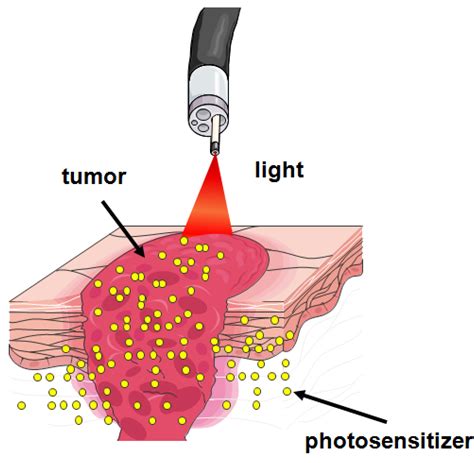 Molecules | Free Full-Text | Aminolevulinic Acid (ALA) as a Prodrug in Photodynamic Therapy of ...