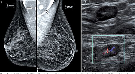 Armpit lymph nodes - samplenibht