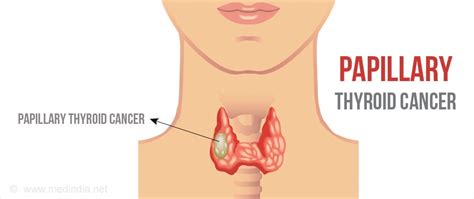 Papillary Thyroid Cancer - Types, Risk Factors, Diagnosis, Treatment